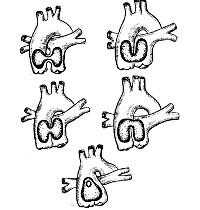 Дефект межжелудочковой перегородки