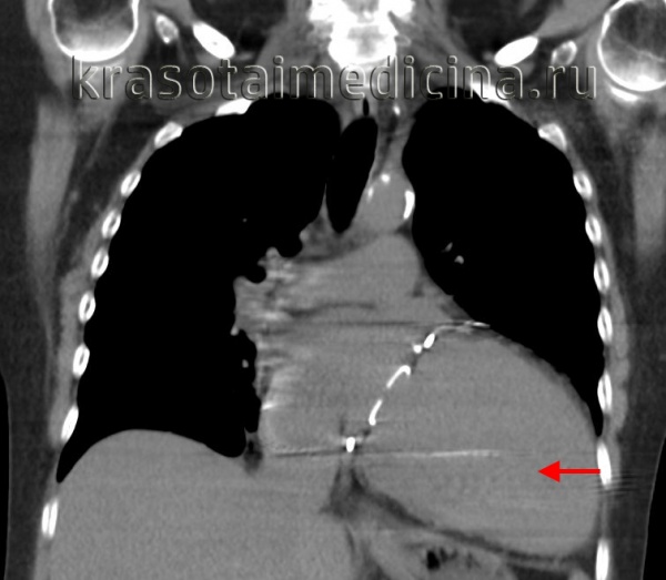 КТ органов грудной клетки. Выраженное расширение сердца (преимущественно левые отделы) у пациента с кардиомиопатией.