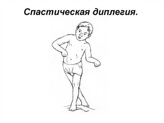 Спастическая диплегия - фото