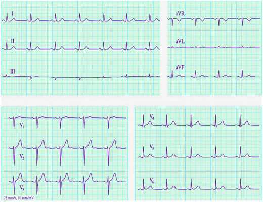 Нормальные показатели ЭКГ