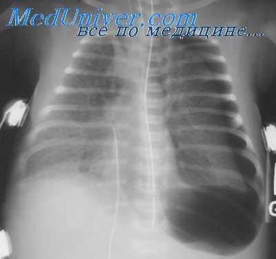 баротравма легких