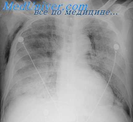 легкие после рекомпрессии