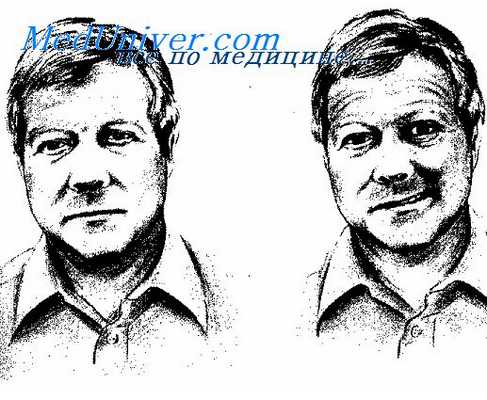 дисфагии при неврологической патологии