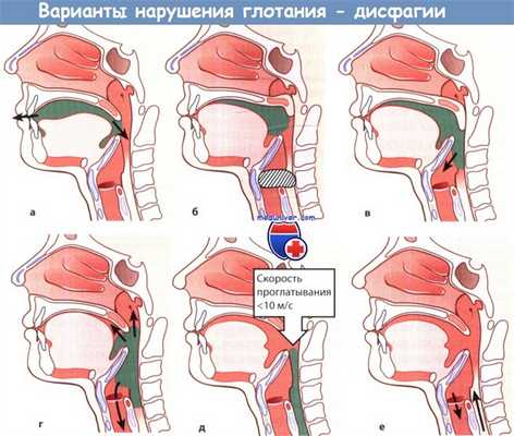 Варианты нарушения глотания (дисфагии)