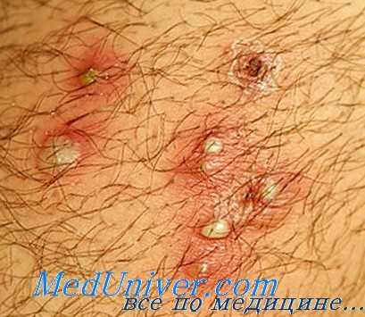 лечение фолликулита