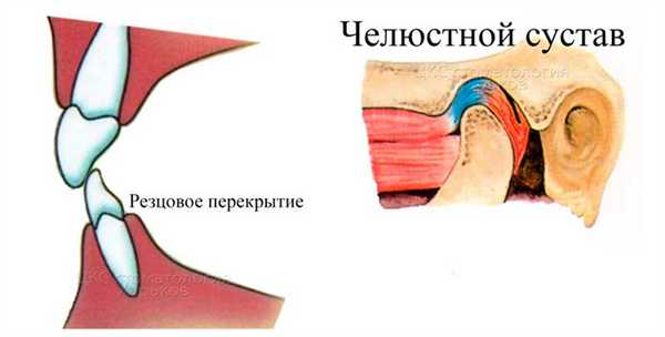 нормальное резцовое перекрытие