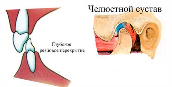 глубокое резцовое перекрытие