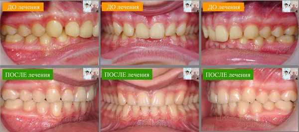Окклюзия ДО и ПОСЛЕ в трех проекциях