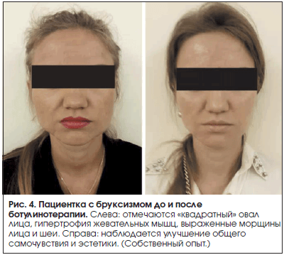 Рис. 4. Пациентка с бруксизмом до и после ботулинотерапии.