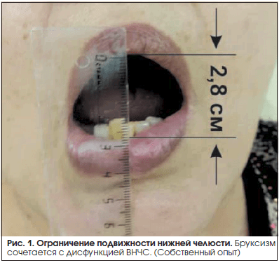 Рис. 1. Ограничение подвижности нижней челюсти.