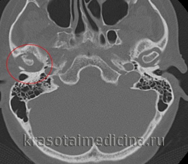 Артрит ВНЧС