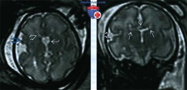 УЗИ, МРТ при агенезии, дисгенезии мозолистого тела головного мозга у плода