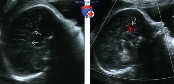 УЗИ, МРТ при агенезии, дисгенезии мозолистого тела головного мозга у плода