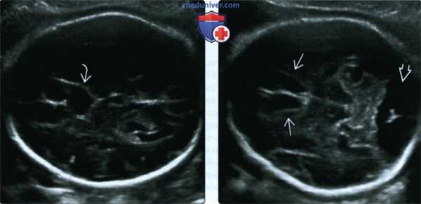 УЗИ, МРТ при агенезии, дисгенезии мозолистого тела головного мозга у плода