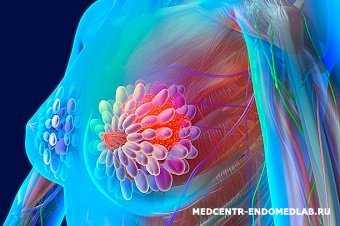 Гиперплазия молочной железы