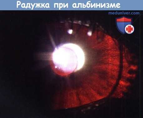 Радужка при альбинизме