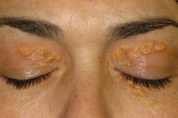 Ксантелазмы на веках - признак гиперхолестеринемии