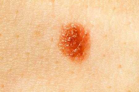 кожный рисунок на родинке.jpg