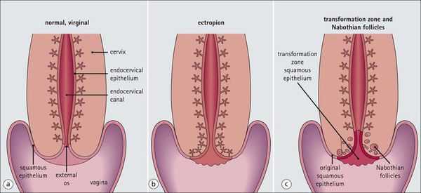 Патогенез эрозии шейки матки