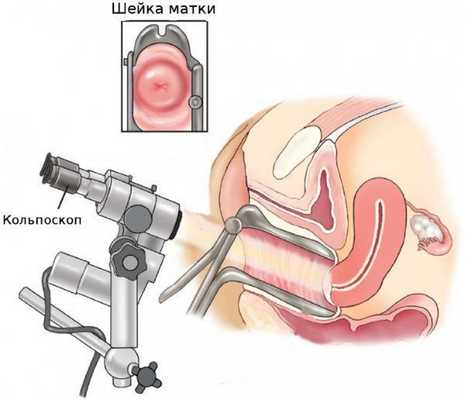 Кольпоскопия
