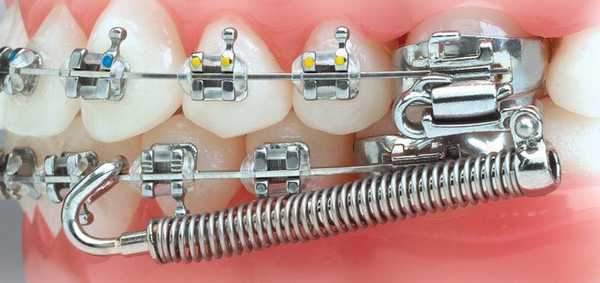 лечение дистального прикуса