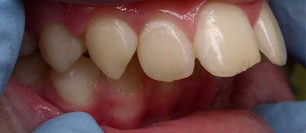 дистальный прикус исправление