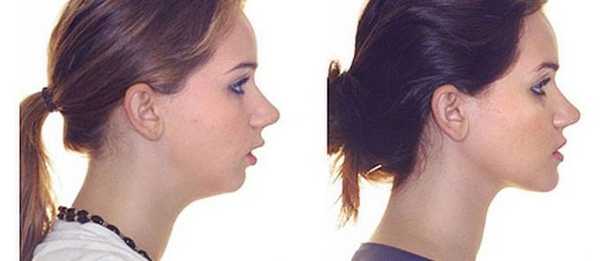 глубокий дистальный прикус лечение