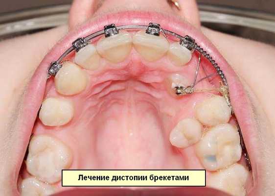 Установка брекетов для лечения дистопии клыков