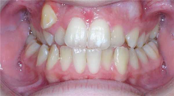 Дистопия зуба