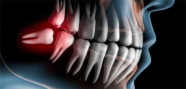 Дистопированные зубы