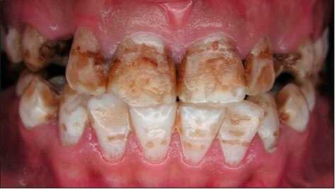 флюороз зубов