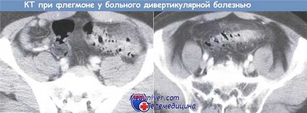 КТ у больного с дивертикулярной болезнью