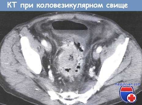 КТ при коловезикулярном свище