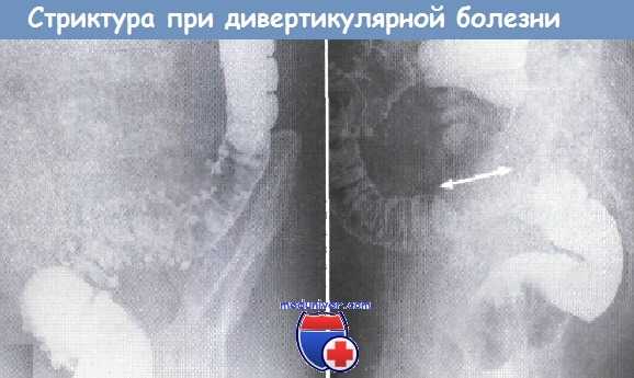 Рентгенограмма при стриктуре у больного с дивертикулярной болезнью