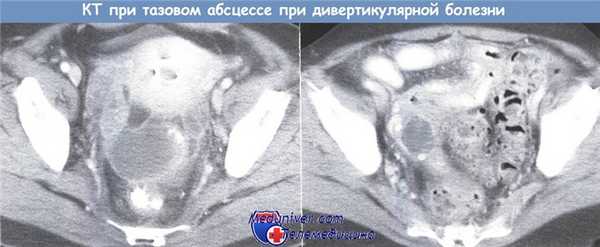 КТ у больного c тазовым абсцессом при дивертикулярной болезни