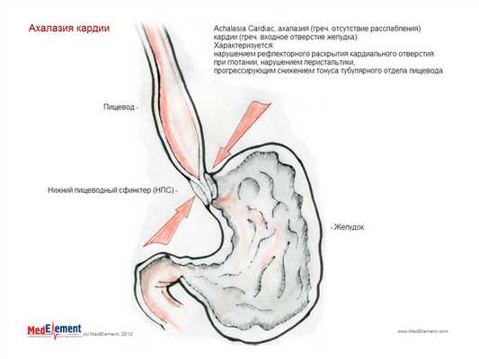 Ахалазия кардиальной части пищевода (ахалазия кардии K22.0). Описание.
