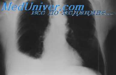 туберкулез плевры