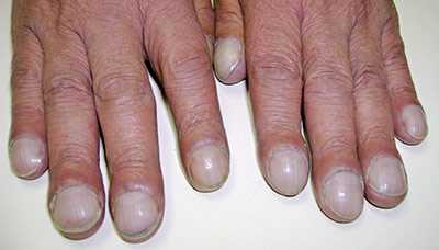 Деформация пальцев при гипоксии