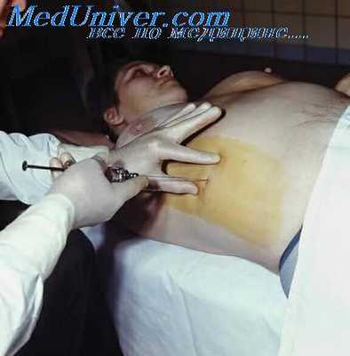 дыхание куссмауля