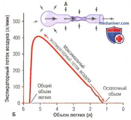 Нарушения вдоха. Максимальный экспираторный поток