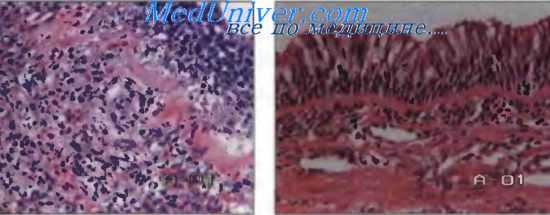 бронхиальная астма