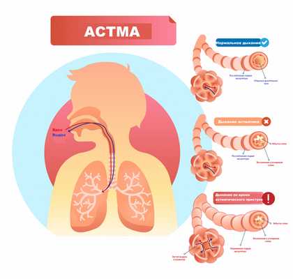Астма.jpg