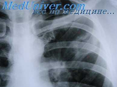 пульмонэктомия