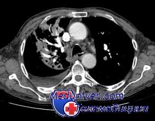 кавернотомия