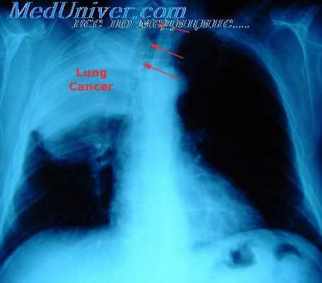 дыхательная недостаточность