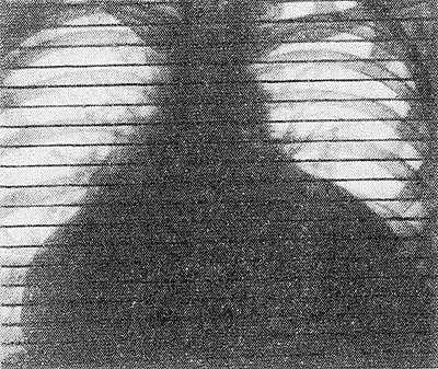 Рис. 5. Рентгенокимограмма сердца при экссудативном перикардите: отсутствие зубцов на контурах сердца свидетельствует об отсутствии их пульсации вследствие накопления жидкости в полости перикарда.