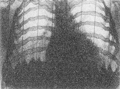 Рис. 2. Рентгенокимограмма диафрагмы и ребер в норме: контуры диафрагмы и ребер имеют зубчатую форму, амплитуда зубцов отражает дыхательные движения (зубцы на контуре сердца не имеют диагностического значения).