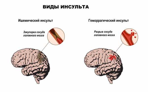 Инсульт.jpg