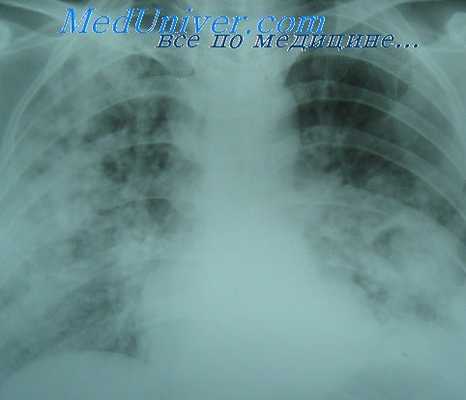 дыхательная недостаточность