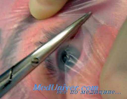 витрэктомия при эндофтальмите